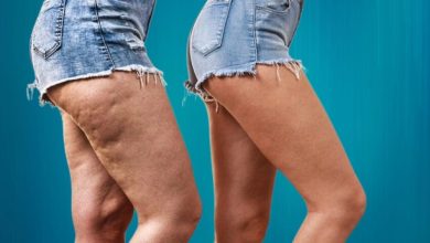 Comprendre le Lipoedeme