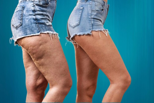 Comprendre le Lipoedeme