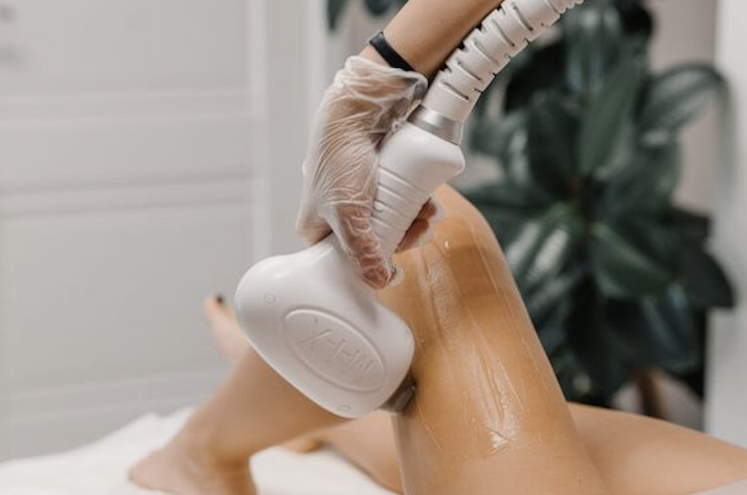 Épilation laser et sterilité: Mythe ou réalité